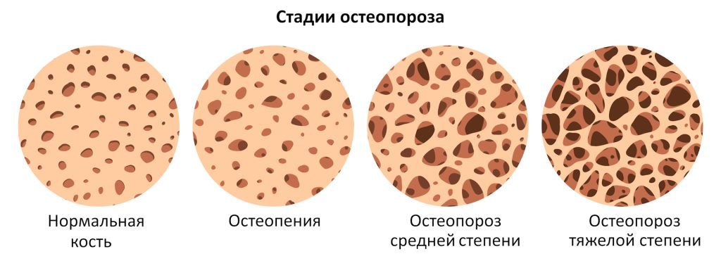 Стадии развития остеопороза